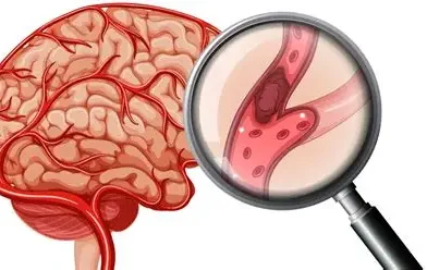 بين الألم النفسي والعبء الجسدي.. حوار مع ابنة مصاب بجلطة في المخ